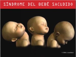 síndrome del bebé sacudido
